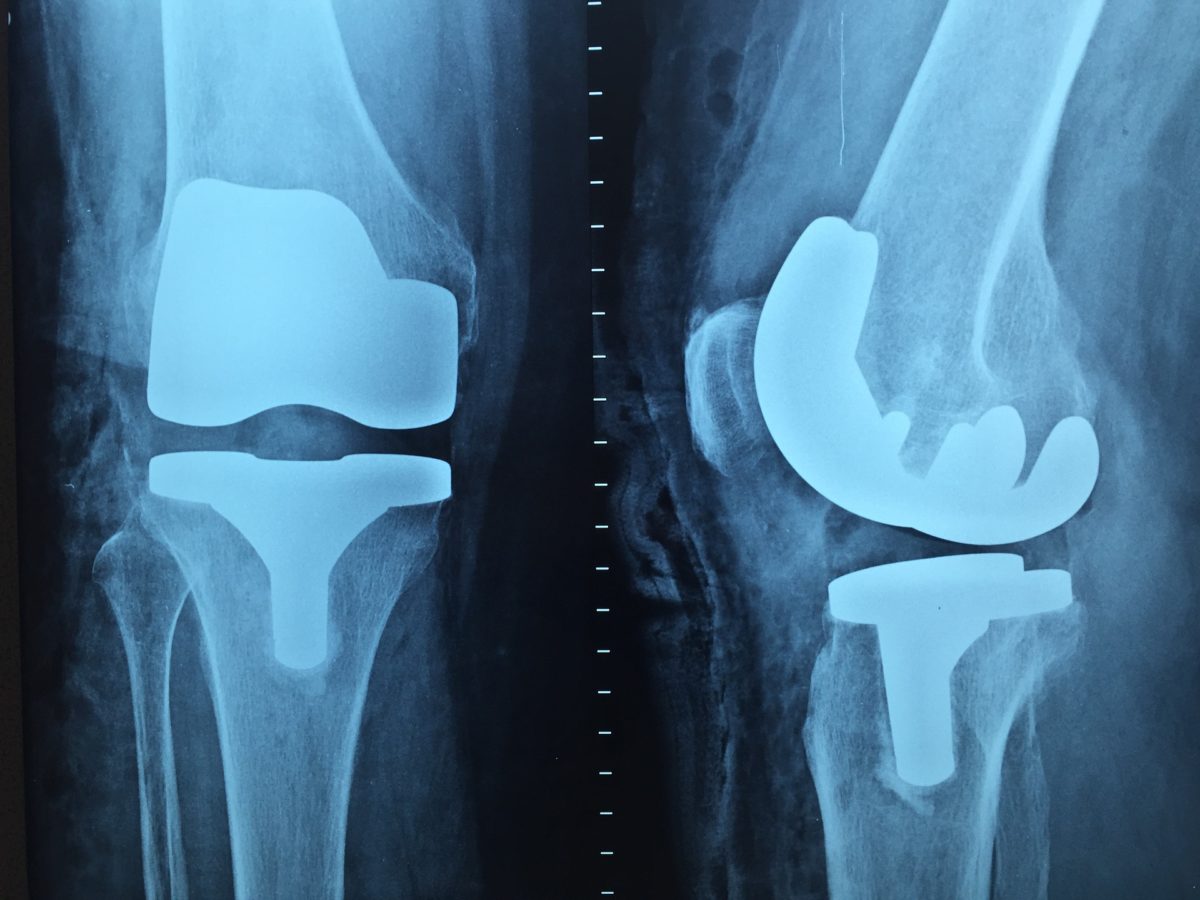 Artroskopia – ratunek dla kolan.